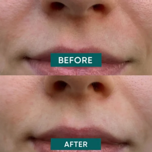 Lipmasker>Apricot Mouth Patches Hyaluron