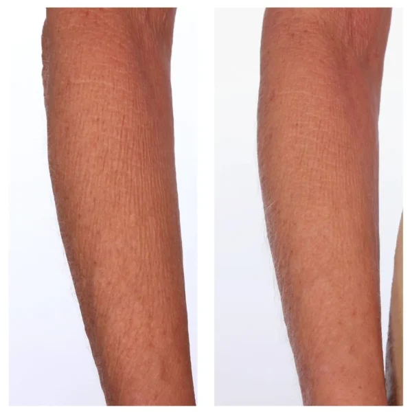 Anti-Cellulitis>U BEAUTY Beauty The Sculpt Arm-Compound