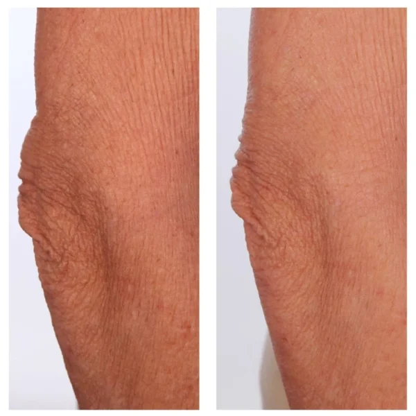 Anti-Cellulitis>U BEAUTY Beauty The Sculpt Arm-Compound